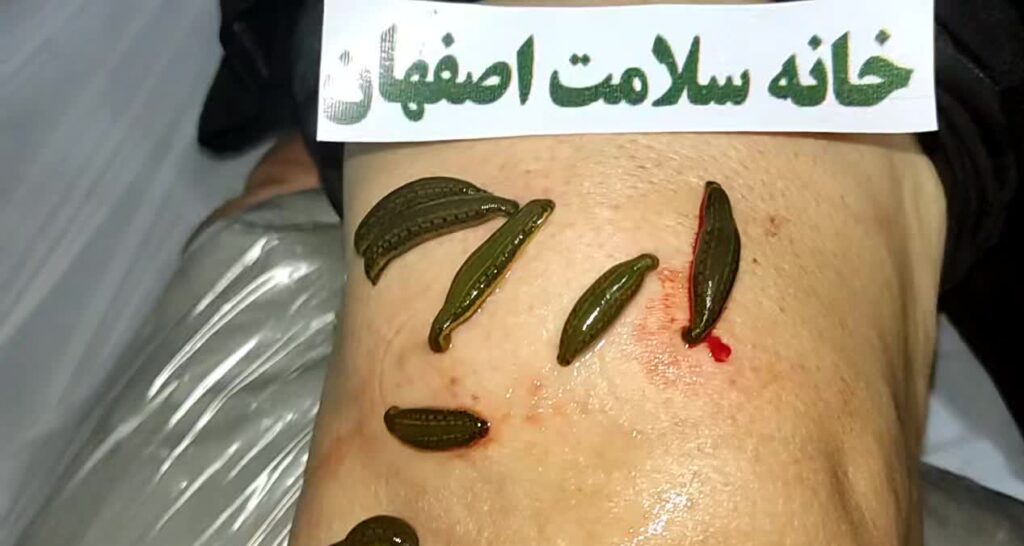 خدمات پاکسازی کبد چرب حجامت طب سوزنی زالو سینوزیت فیلر